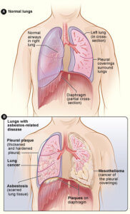 Normaalit keuhkot ja asbestisairaudet keuhkoissa